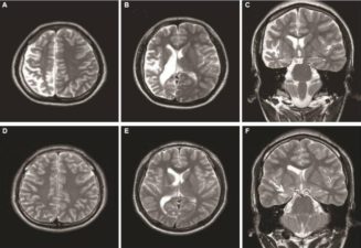MRI